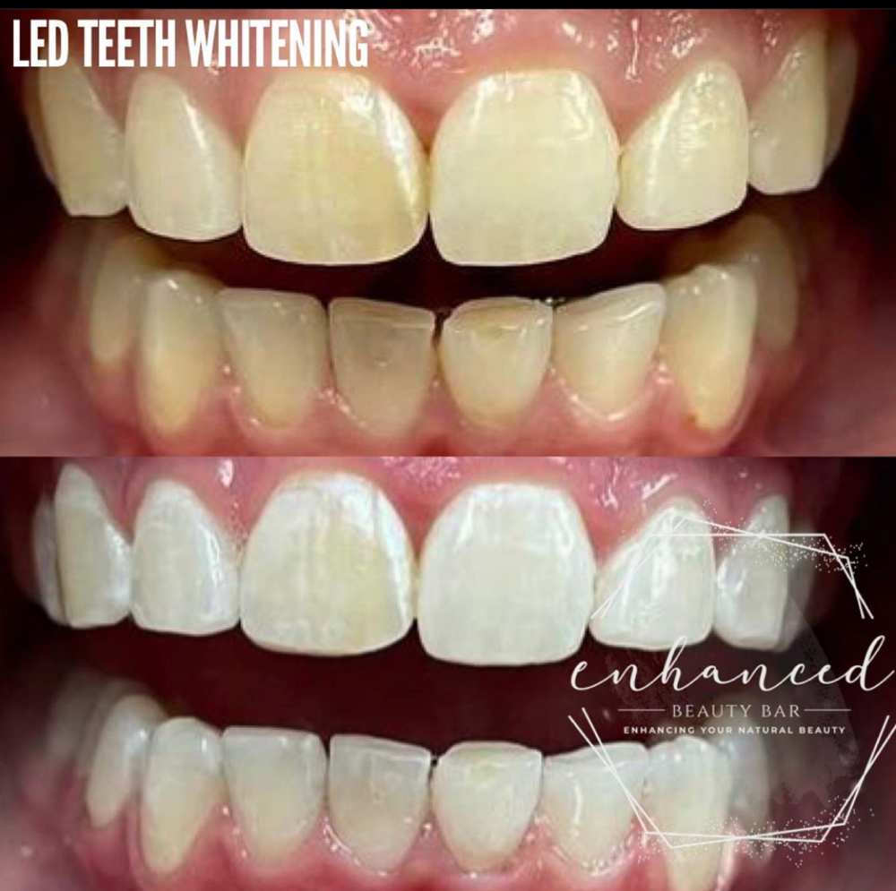 Teeth Whitening