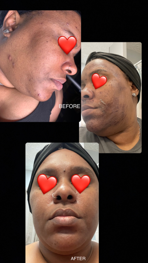 Acne System