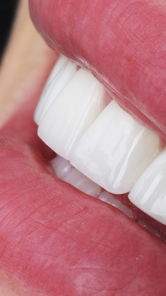 Cosmetic Teeth Whitening
