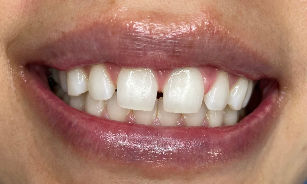 60MIN TEETH WHITENING