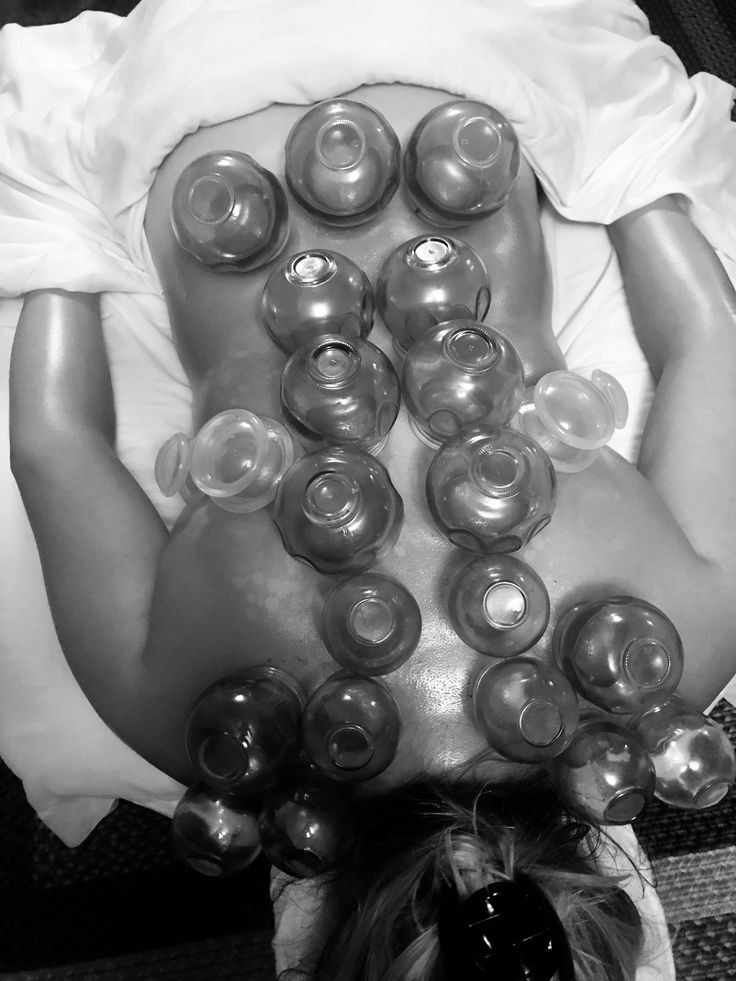 Cupping Add-On