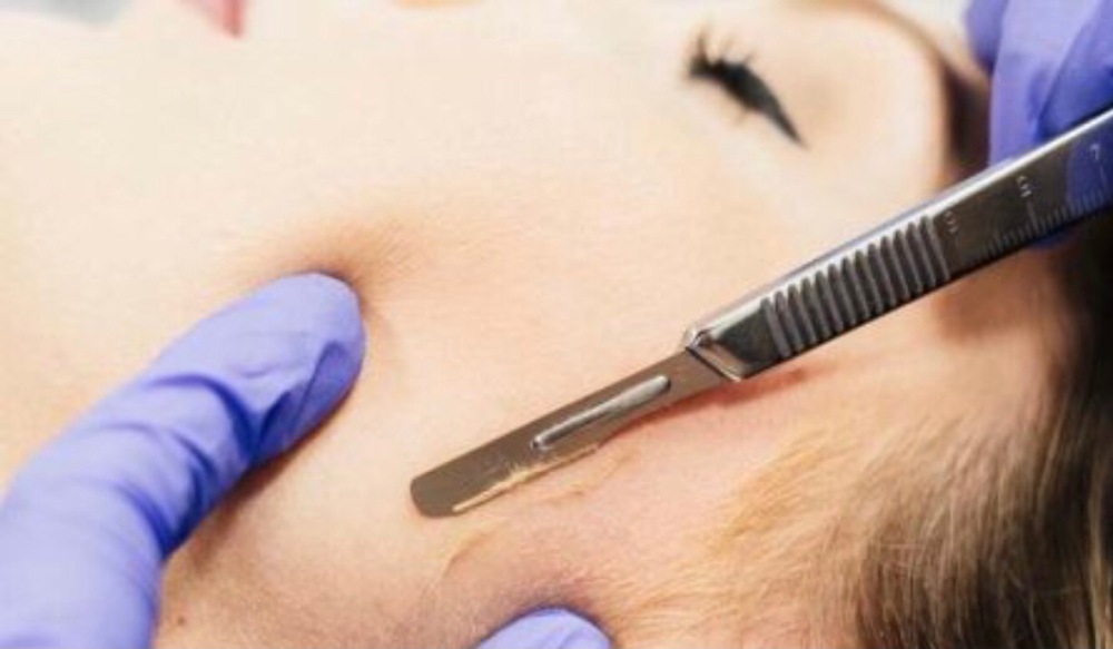 Dermaplane Only