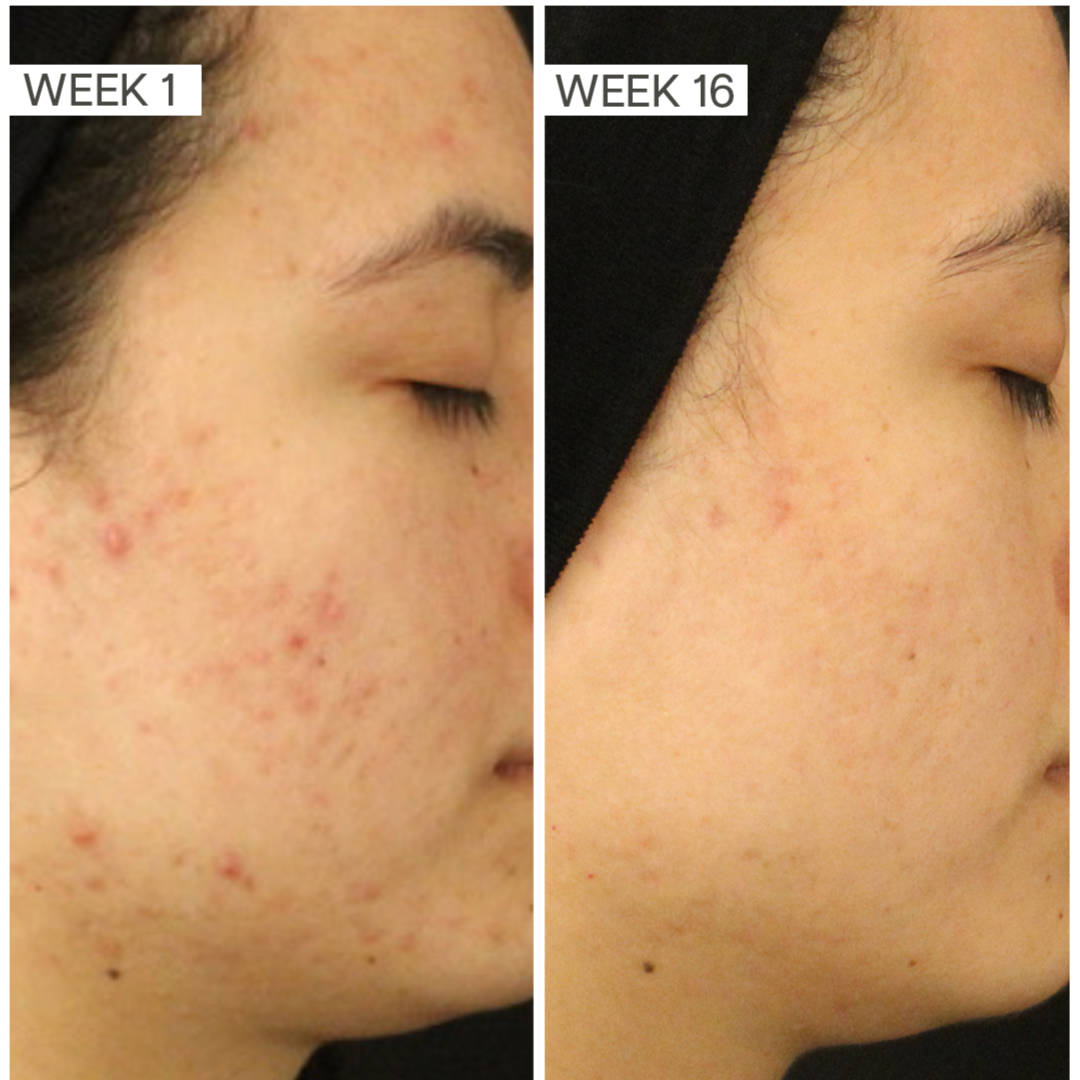 Acne Bootcamp at Bare Skin Esthetics in Roseville, CA