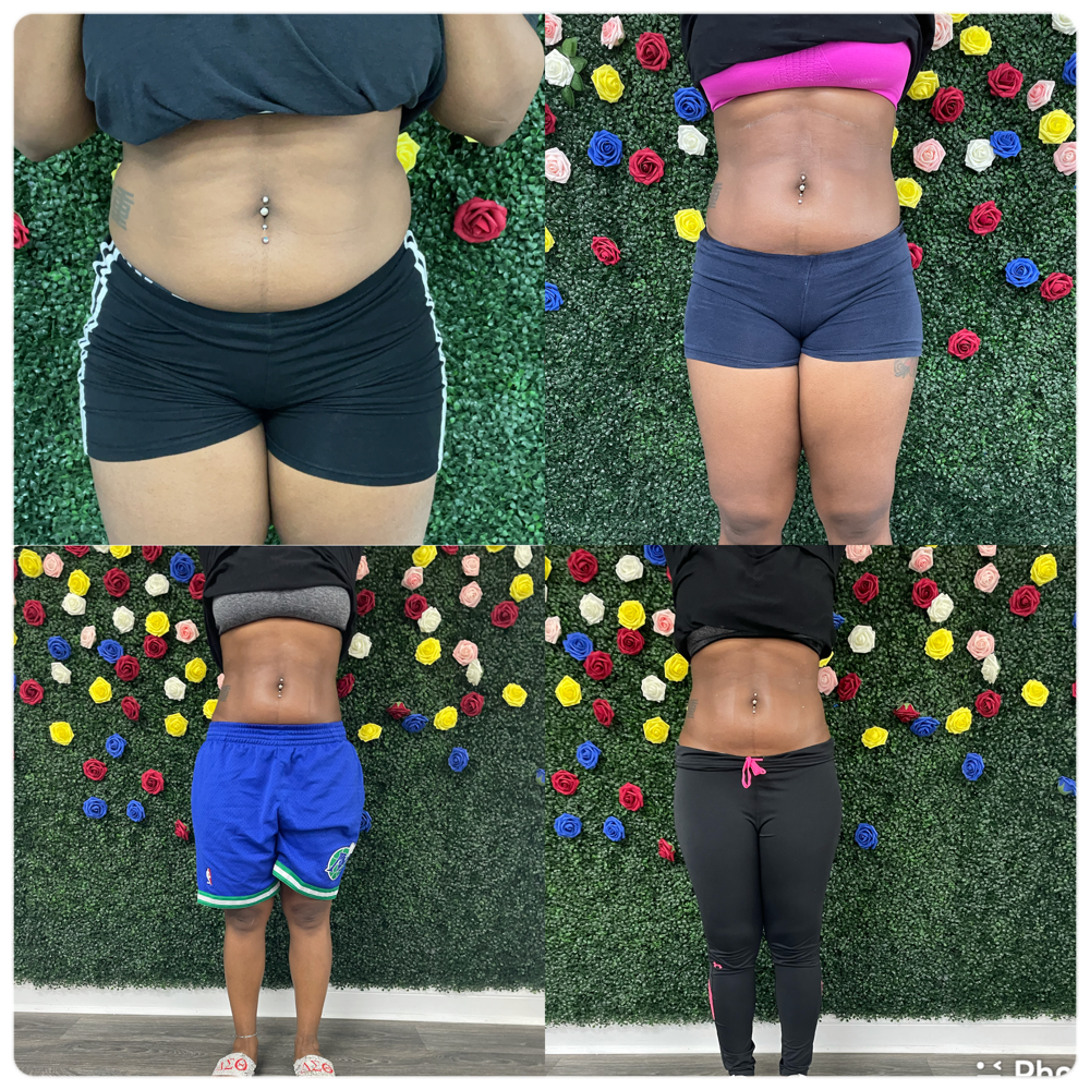 Body Sculpting (stomach)
