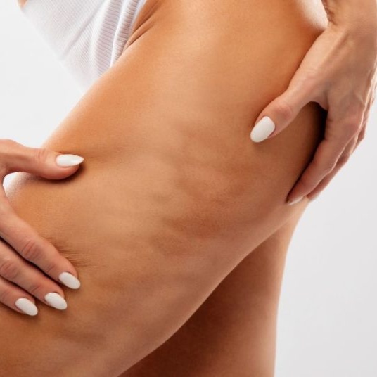 CELLULITE TREATMENT at 3B Wellness Boutique in Jensen Beach, FL