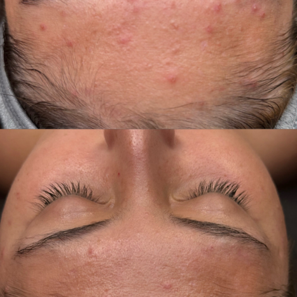 TEEN ACNE CONSULTATION + TREATMENT at Lashes+corrective skincare+waxing+brows in Temecula, CA