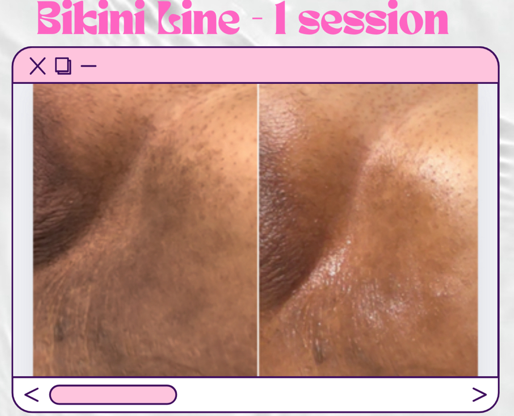 Skin Lightening - Bikini Line