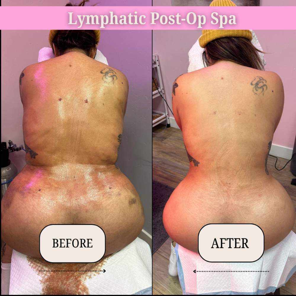 Post-Op Lymphatic Drainage Massage at Lymphatic Post-Op Spa in San Diego, CA