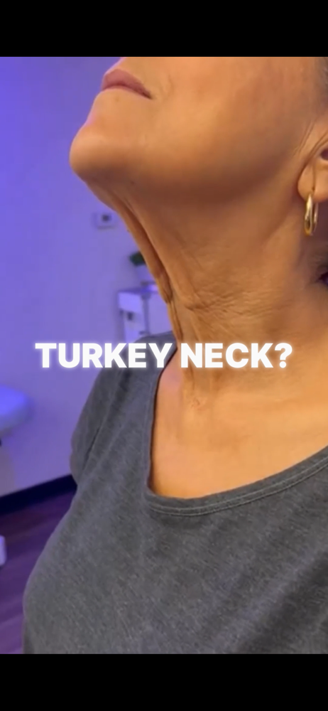 Special - Turkey Neck Cryo slimming