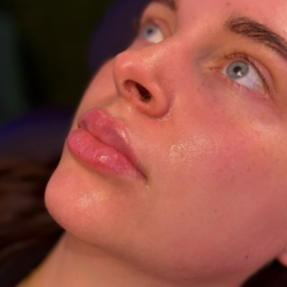 Mini Lip ( Half Syringe) at Enliven You Aesthetics & Wellness in Dallas, TX