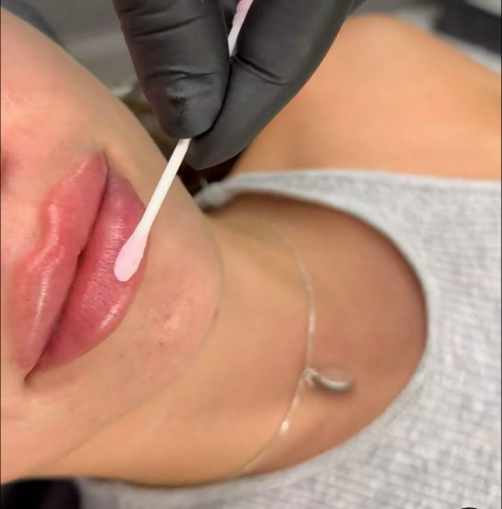 ✨1/2 lip filler ✨