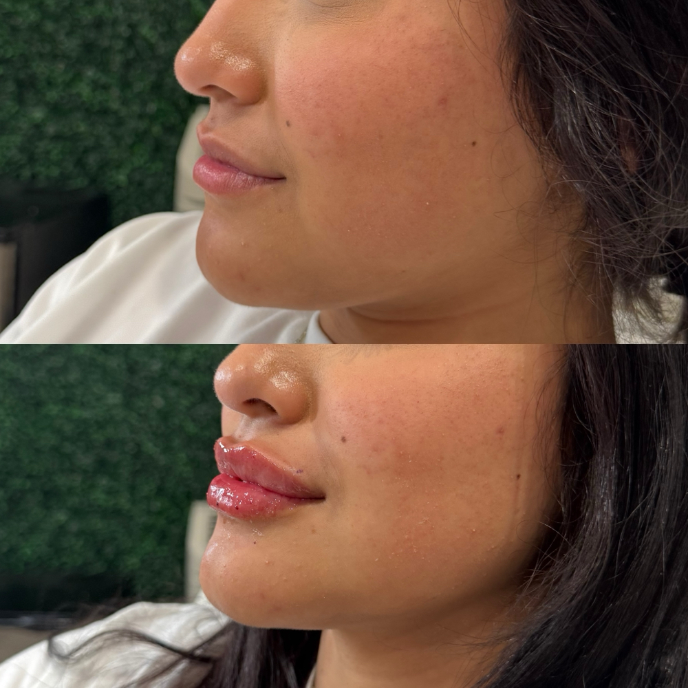 Lip Fillers