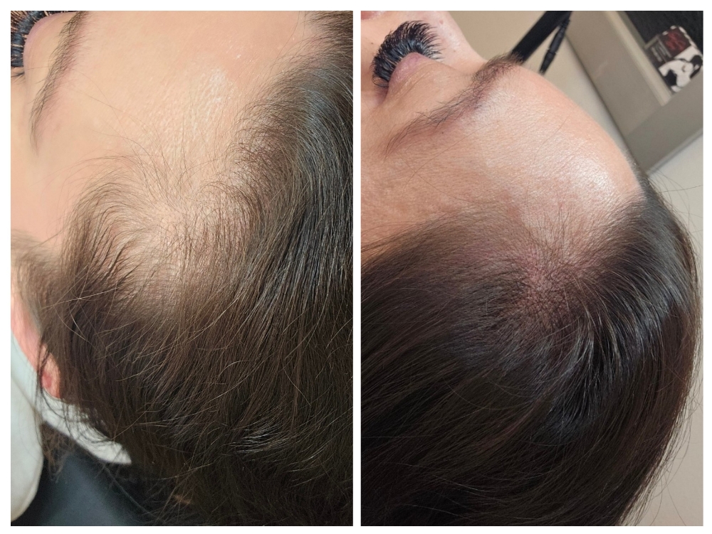Scalp Micropigmentation (SMP)
