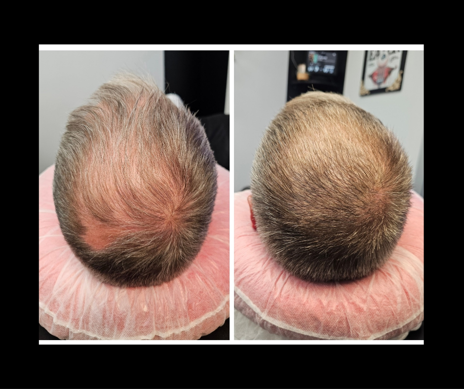 Scalp Hair Density (SMP/Strokes)