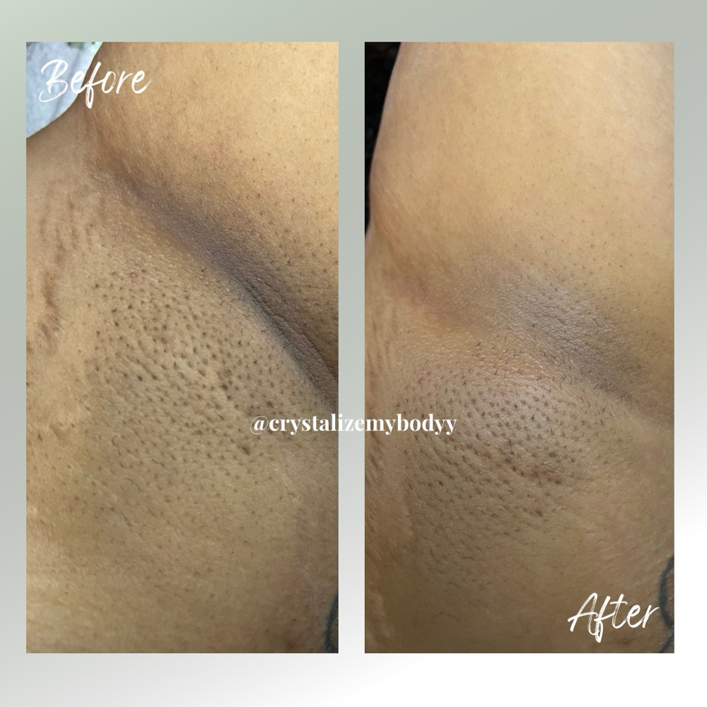 Skin Brightening (6 Sessions)