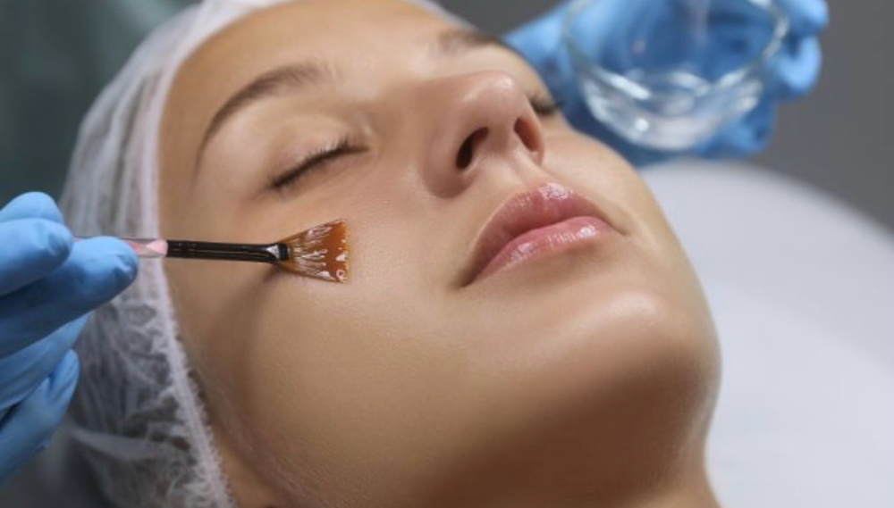 Chemical peel