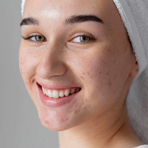 ACNE & OIL CONTROL at Star Spa Lash & Brow By: Evelyn Esthetician in Oakland, NJ