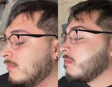 Beard Micropigmentation