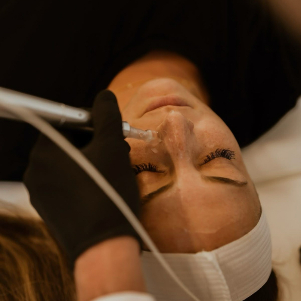 Microneedling at Glo Up Bar in Saratoga springs, UT