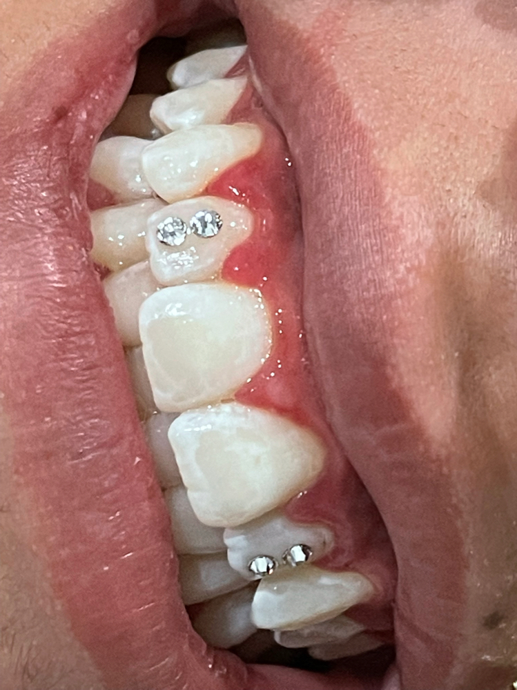 Single Toothgem