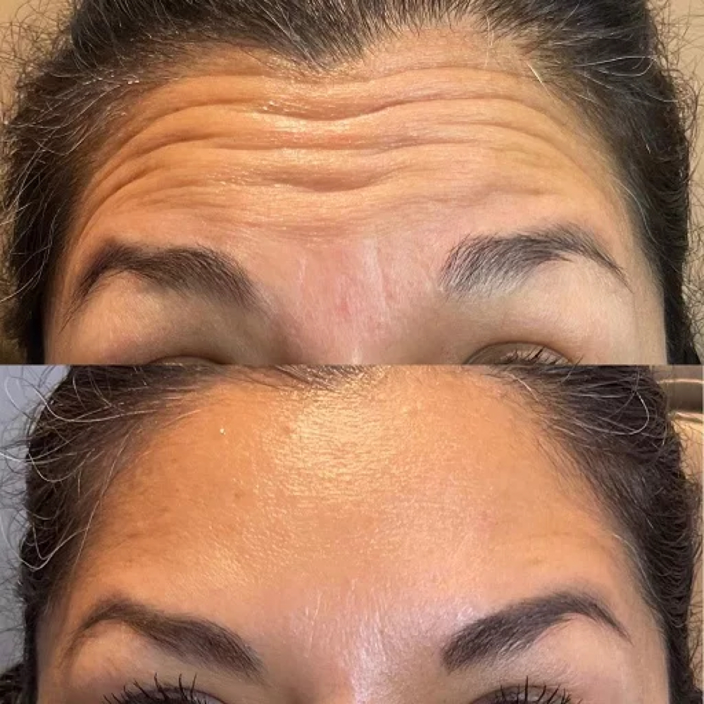 Forhead Botox at The Inkjectables Lab in El Paso, TX