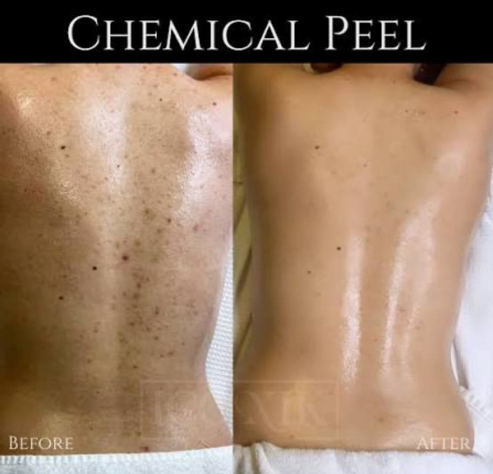 chemical peel on back