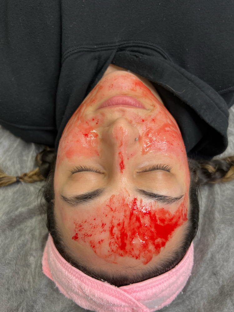 Microneedeling