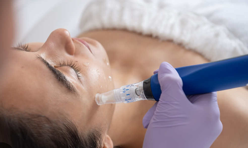Microneedling With Exosomes