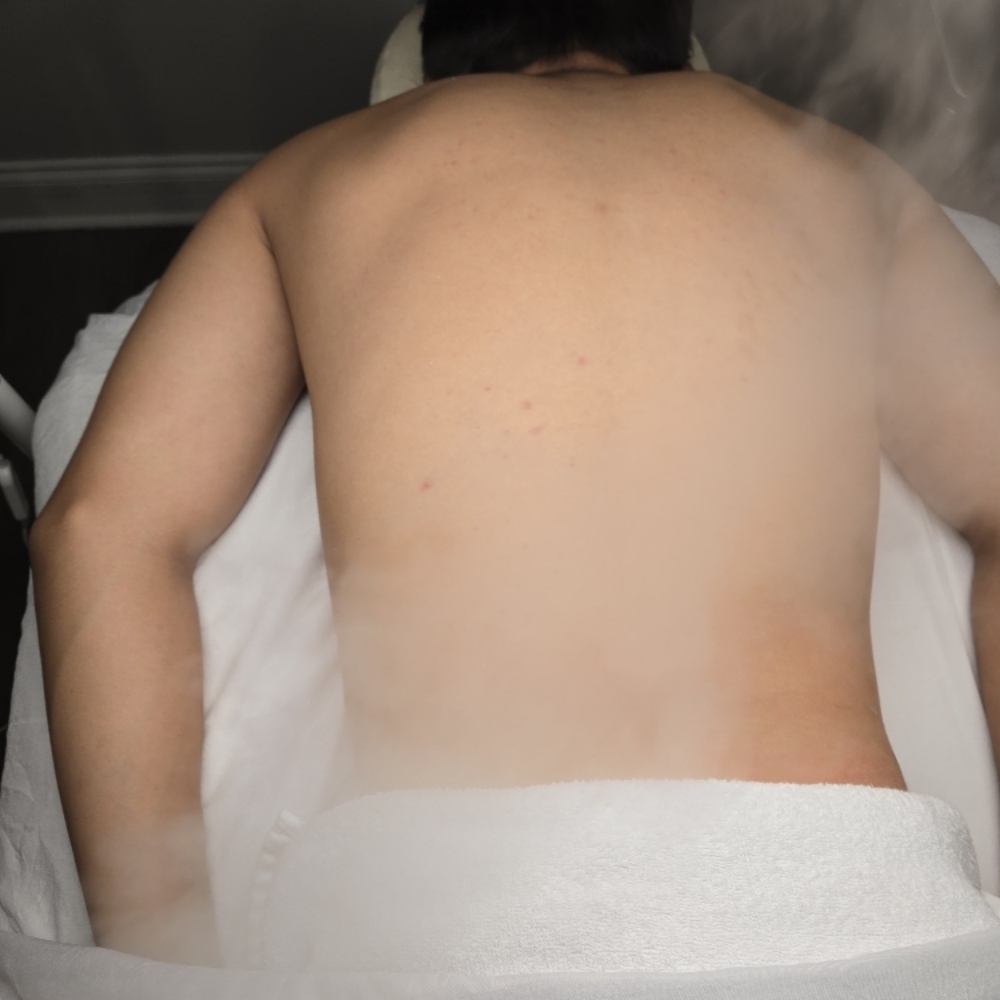 Radiance Back Renewal at Midtown Esthetics in Raleigh, NC