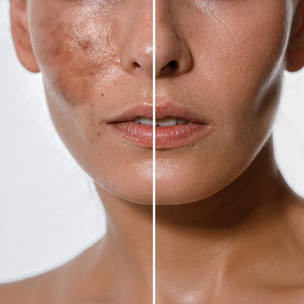Clinical Corrective Peel at MKD Aesthetics in Surprise, AZ