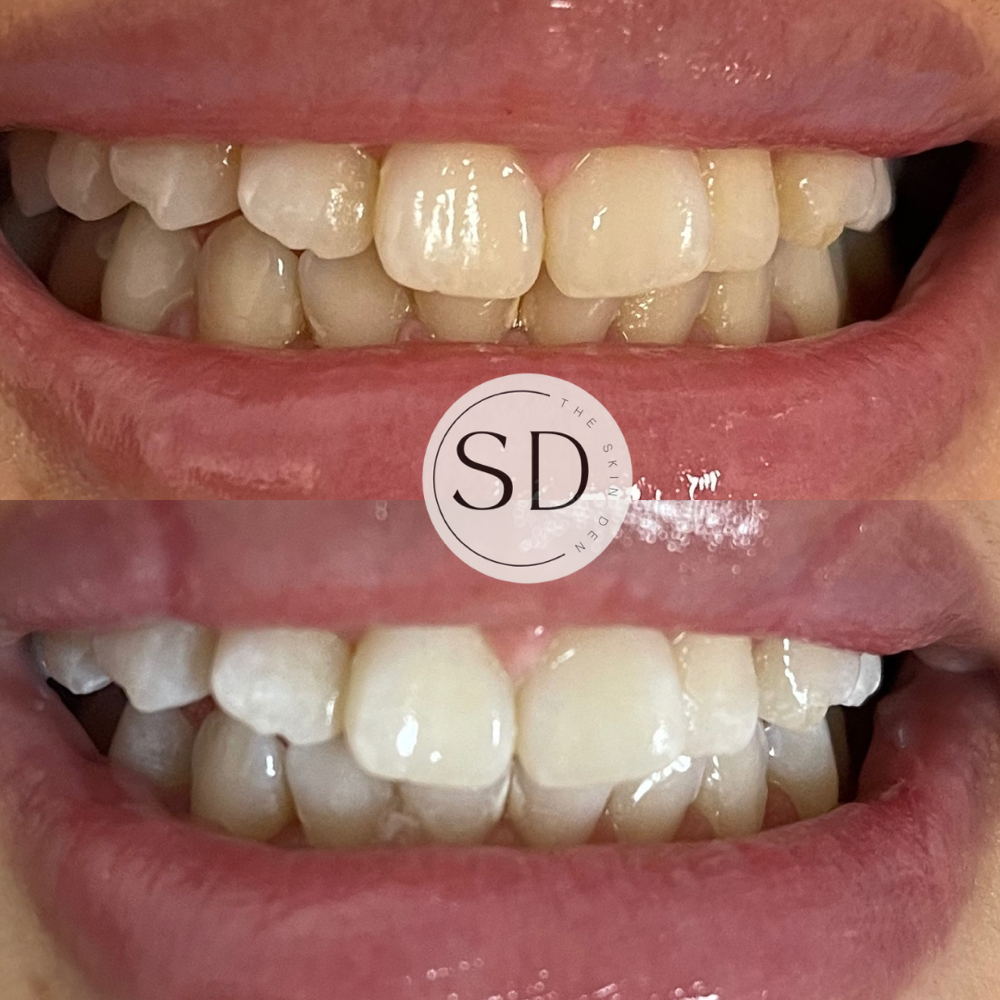 Teeth Whitening