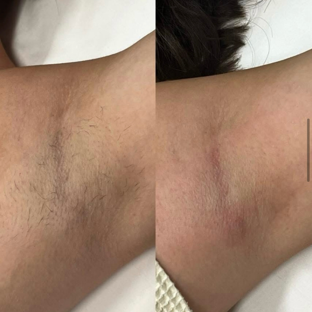 Underarm Wax at Bare Face Beauty LLC in Greenwood, IN