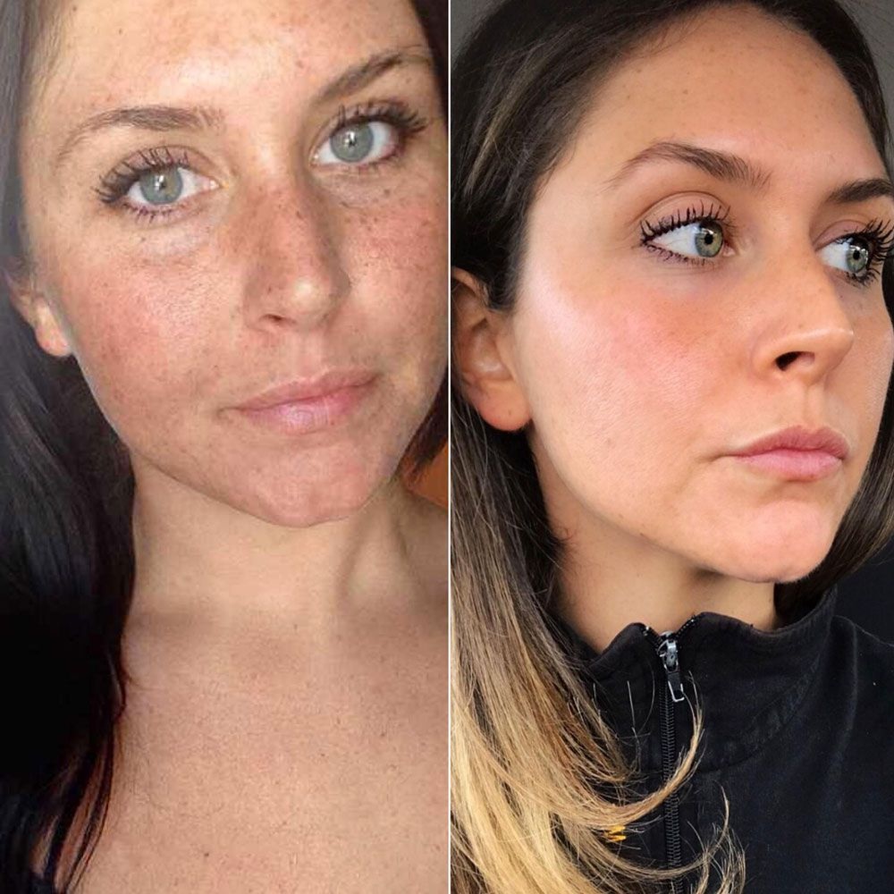 Sun Spots (Laser Treatment) at Corrective treatments + professional skincare in Atlanta, GA
