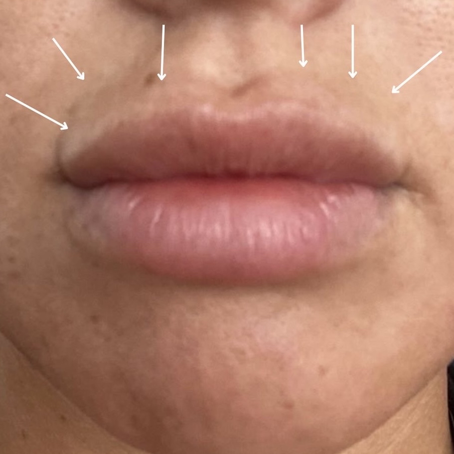 Lip filler migration treatment