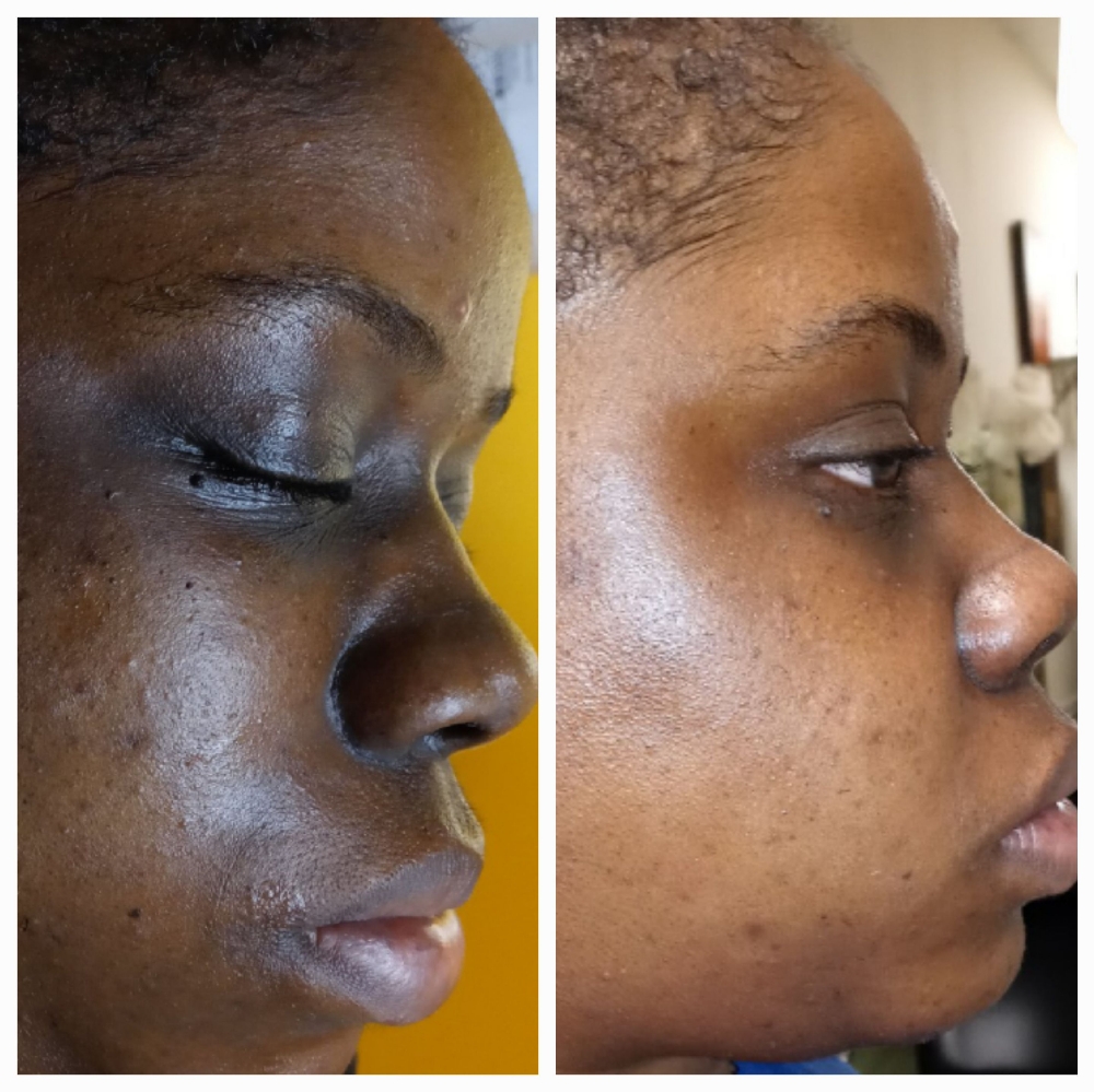 After PEEL Facial
