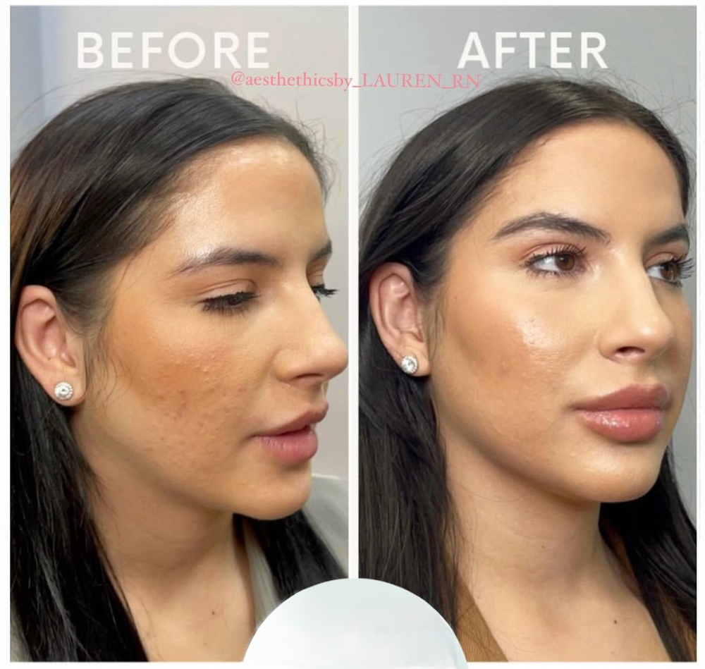 VI Chemical Peel