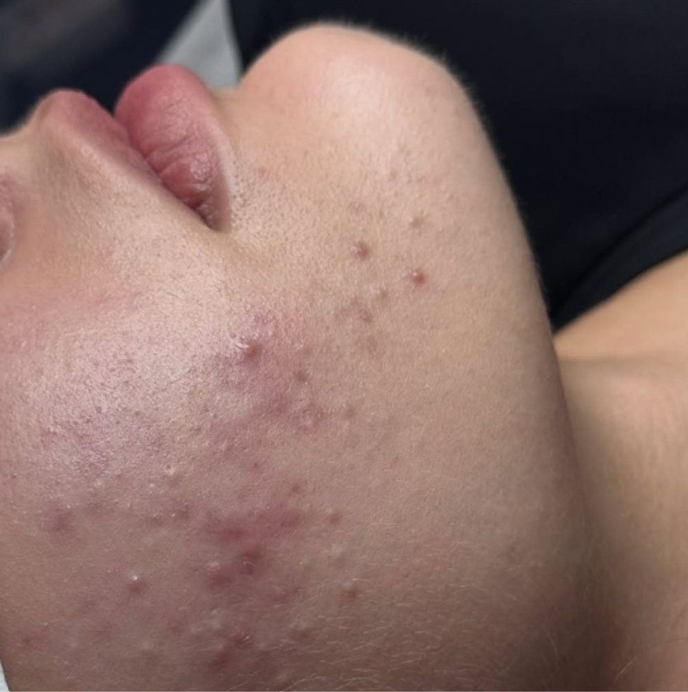 Acne & Clarifying Facial