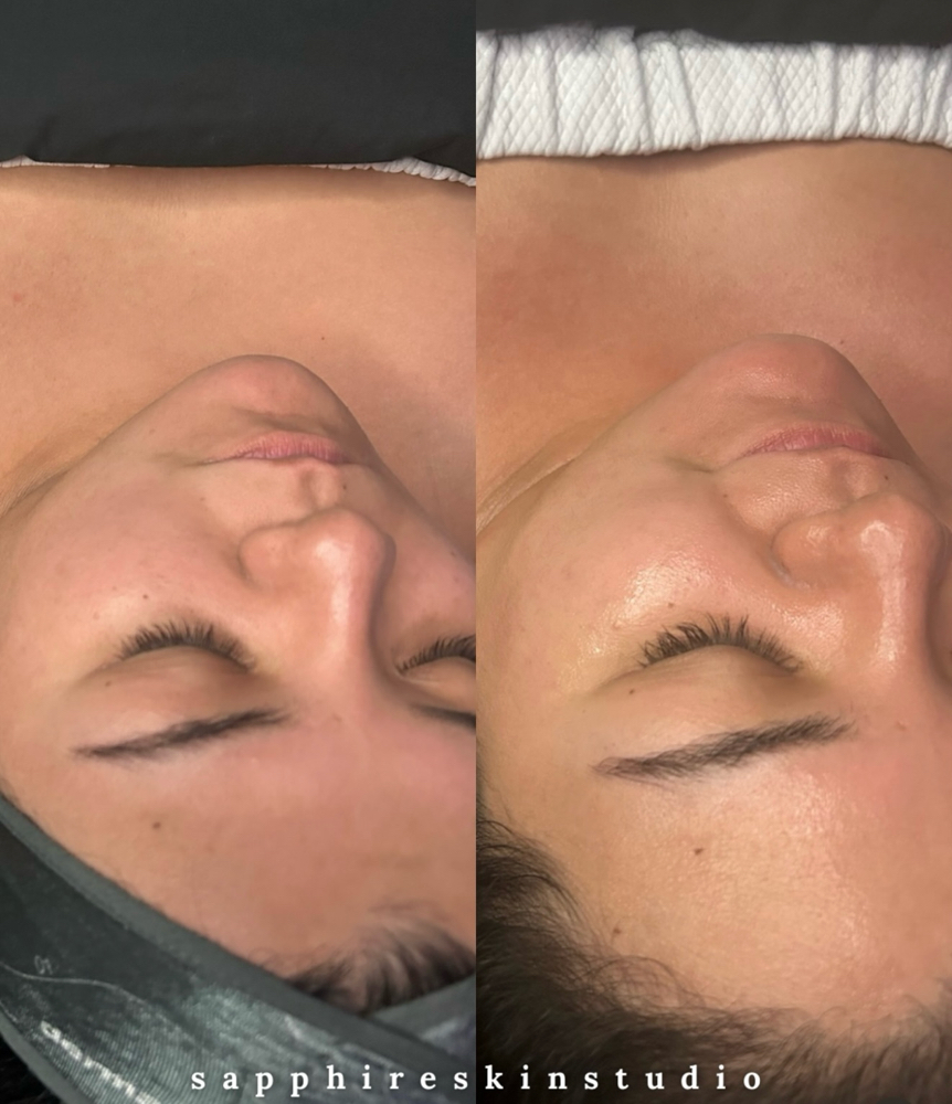 Facial Treatment
