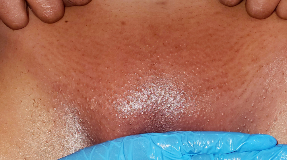 Brazilian Wax