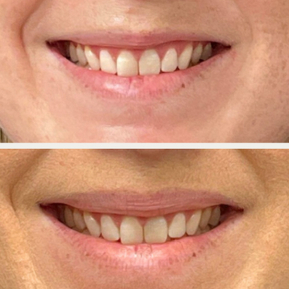 Lip Flip at Beauty Lounge Prosper in McKinney, TX