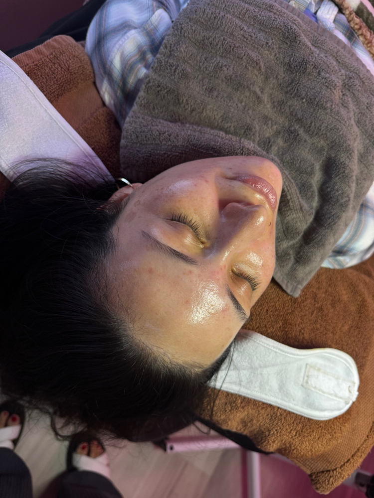 Acne Facial