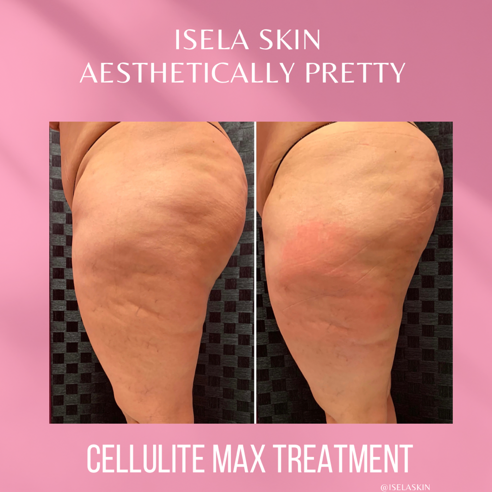 Cellutie Max Treatment