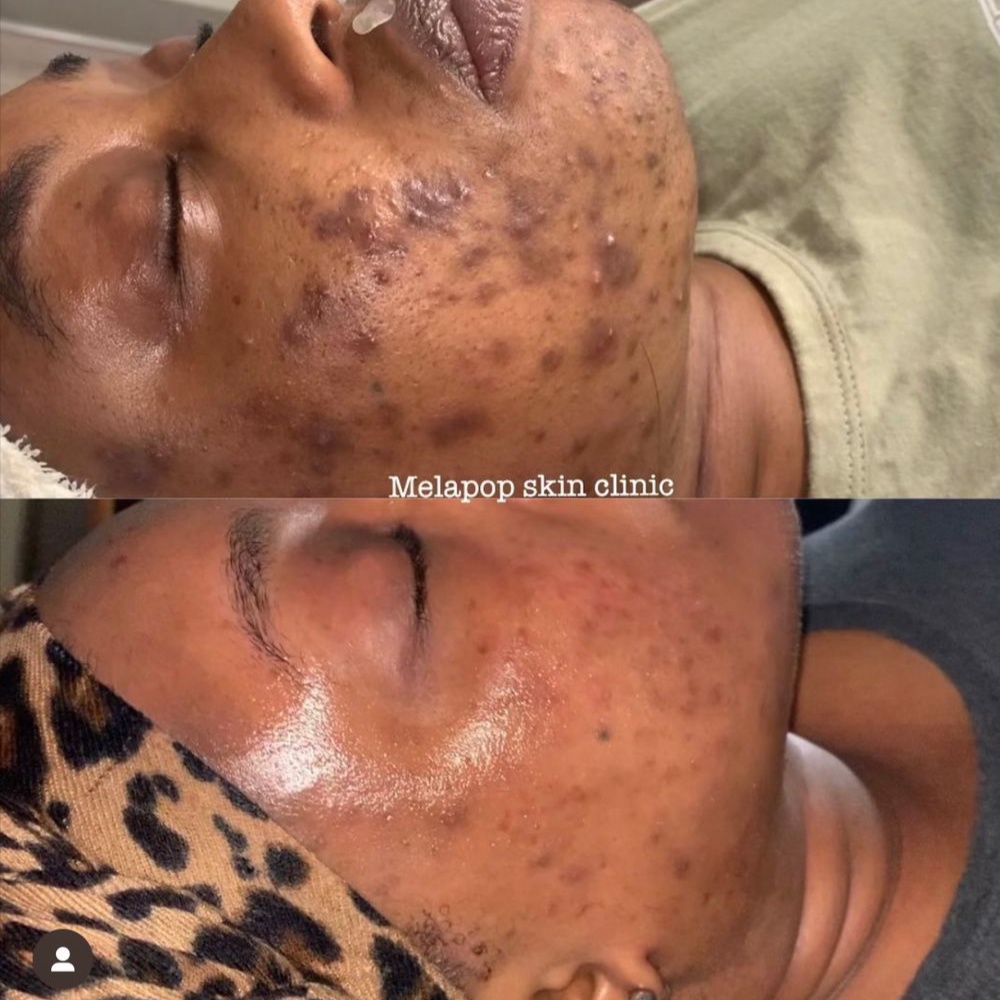 Rich Radiance™ Pigment Program at Melapop aesthetics & Wellness in Houston, TX