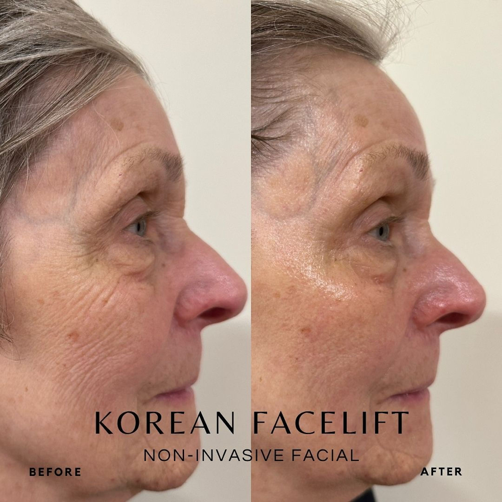 Korean  Facelift Facial at Glowing Beauty by Gennie in Kankakee, IL