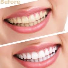 Teeth Whitening