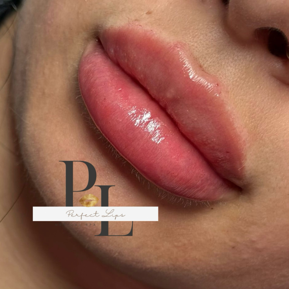 0.5 ML Juvederm / Restylane