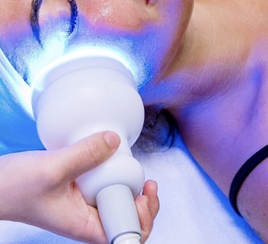 Cryo Facial 5 Sessions