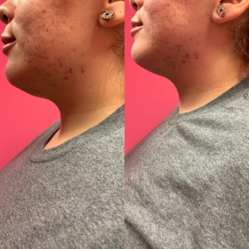 Neck And Chin Lipo Cavitation