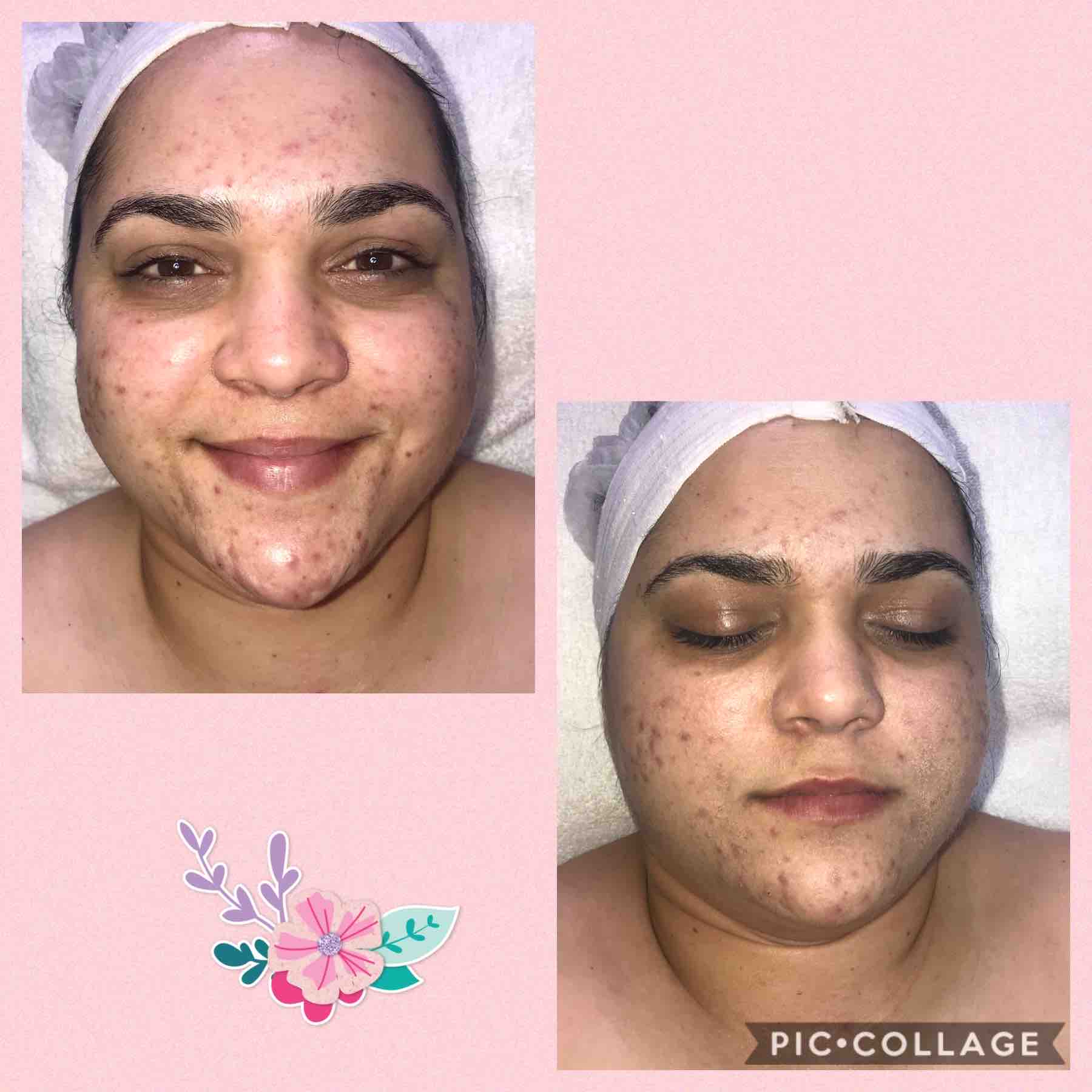 Anti-Acne Facial