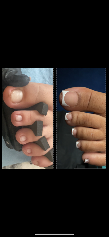 Reconstruction Toes (Dry)